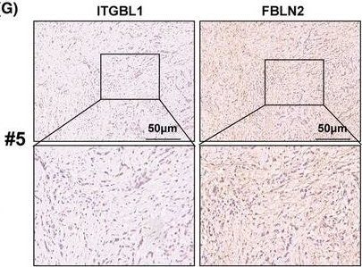 Fig.3.G showing Immunohistochemistry in a Homo sapiens (Human) sample from the publication: ITGBL1 promotes anoikis resistance and metastasis in human gastric cancer via the AKT/FBLN2 axis.