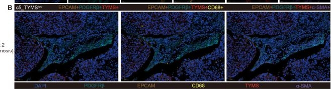 Fig.5.B showing Immunohistochemistry-immunofluorescence in a Homo sapiens (Human) sample from the publication: Single-cell sequencing analysis reveals cancer-associated pericyte subgroup in esophageal squamous cell carcinoma to predict prognosis.