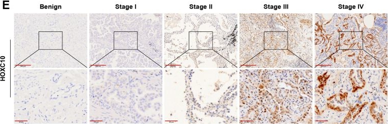 Fig.7.E showing Immunohistochemistry from the publication: Pan-cancer analysis of homeodomain-containing gene C10 and its carcinogenesis in lung adenocarcinoma.