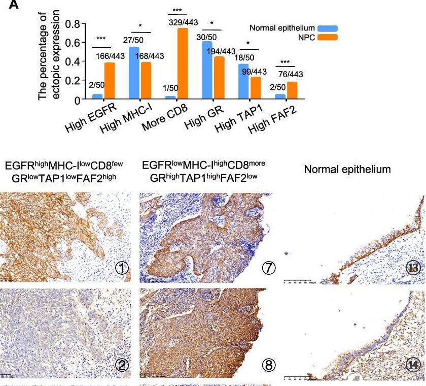 Fig.6.A showing Immunohistochemistry in a Homo sapiens (Human) sample from the publication: Targeting EGFR-binding protein SLC7A11 enhancing antitumor immunity of T cells via inducing MHC-I antigen presentation in nasopharyngeal carcinoma.