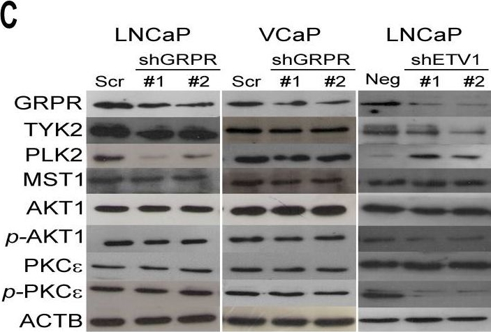 Fig.4.C showing Western Blotting in a Homo sapiens (Human) sample from the publication: Uncovering potential downstream targets of oncogenic GRPR overexpression in prostate carcinomas harboring ETS rearrangements.