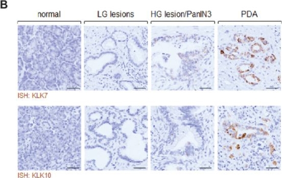 Fig.2.B showing Immunohistochemistry from the publication: Kallikrein related peptidases 7 and 10 and their substrate desmoglein 3 are upregulated in early stage pancreatic cancerous lesions.