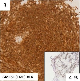 Fig.1.B showing Immunohistochemistry in a Homo sapiens (Human) sample from the publication: A2AR Expression and Immunosuppressive Environment Independent of KRAS and GNAS Mutations in Pseudomyxoma Peritonei.