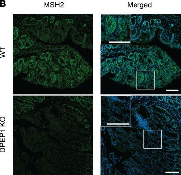 Fig.5.B showing Immunohistochemistry-immunofluorescence in a Homo sapiens (Human) sample from the publication: Dipeptidase-1-knockout mice develop invasive tumors with features of microsatellite-unstable colorectal cancer.
