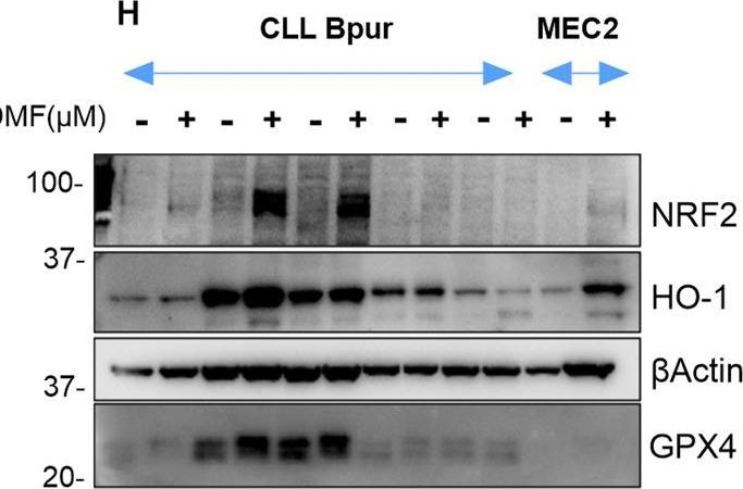 Fig.3.H showing Western Blotting from the publication: Disrupting pro-survival and inflammatory pathways with dimethyl fumarate sensitizes chronic lymphocytic leukemia to cell death.