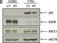Fig.2.D showing Western Blotting from the publication: Radiotherapy modulates expression of EGFR, ERCC1 and p53 in cervical cancer.