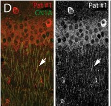 Fig.3.D showing Immunohistochemistry-immunofluorescence from the publication: Coexistence of CN1A autoantibodies in GAD65 encephalitis exacerbates neurodegeneration : Novel autoantibodies in GAD65 encephalitis.