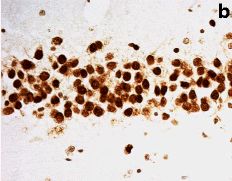 Fig.1.B showing Immunohistochemistry-paraffin in a Homo sapiens (Human) sample from the publication: Heterogeneous ribonuclear protein A3 (hnRNP A3) is present in dipeptide repeat protein containing inclusions in Frontotemporal Lobar Degeneration and Motor Neurone disease associated with expansions in C9orf72 gene.