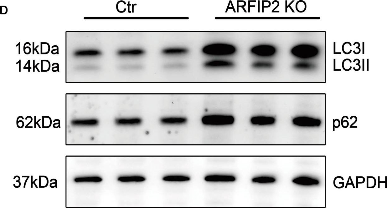 ADP-Ribosylation Factor-Interacting Protein 2 Acts as a Novel Regulator of Mitophagy and Autophagy in Podocytes in Diabetic Nephropathy.