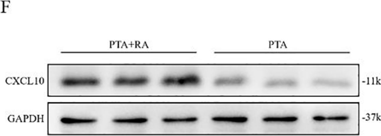Fig.6.F showing Western Blotting from the publication: Identification and validation of the common pathogenesis and hub biomarkers in Papillary thyroid carcinoma complicated by rheumatoid arthritis.
