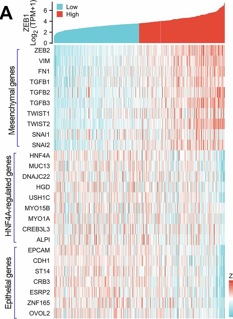 Fig.8.A showing Immunohistochemistry from the publication: Hypermethylation-mediated HNF4A silencing by Helicobacter pylori infection drives gastric cancer by disrupting epithelial cell polarity and activating EMT signaling.