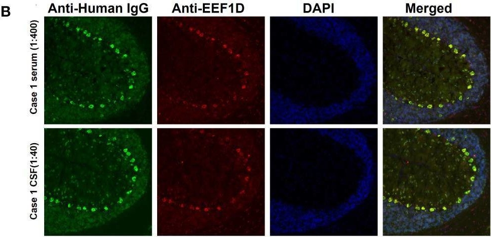 Fig.2.B showing Immunocytochemistry-immunofluorescence in a Homo sapiens (Human) sample from the publication: Autoantibodies against eukaryotic translation elongation factor 1 delta in two patients with autoimmune cerebellar ataxia.
