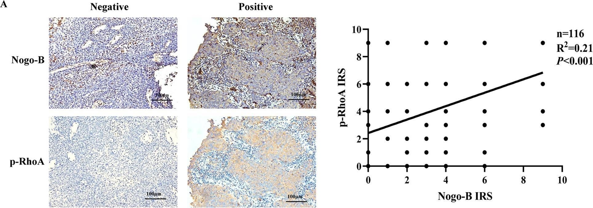 Fig.7.A showing Immunohistochemistry in a Homo sapiens (Human) sample from the publication: Nogo-B promotes invasion and metastasis of nasopharyngeal carcinoma via RhoA-SRF-MRTFA pathway.