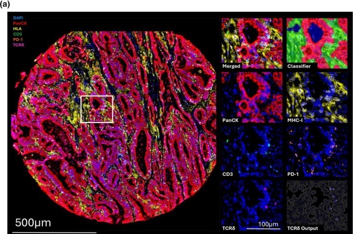 Fig.2.A showing Immunohistochemistry-immunofluorescence in an Equus caballus (Horse) sample from the publication: Characterisation of tumor-infiltrating gamma-delta T&nbsp;cells in human colorectal cancer with MHC-I loss.