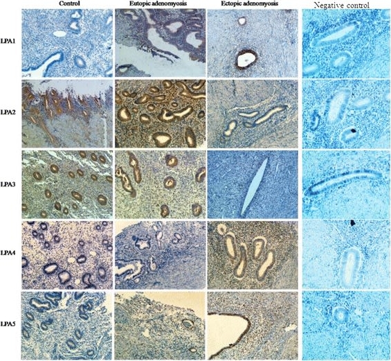 Fig.1.A showing Immunohistochemistry in a Homo sapiens (Human) sample from the publication: Elevated plasma levels of lysophosphatidic acid and aberrant expression of lysophosphatidic acid receptors in adenomyosis.