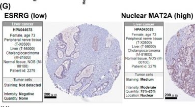 Fig.5.G showing Immunohistochemistry in a Homo sapiens (Human) sample from the publication: Translocation of Methionine Adenosyl Transferase MAT2A and Its Prognostic Relevance for Liver Hepatocellular Carcinoma.