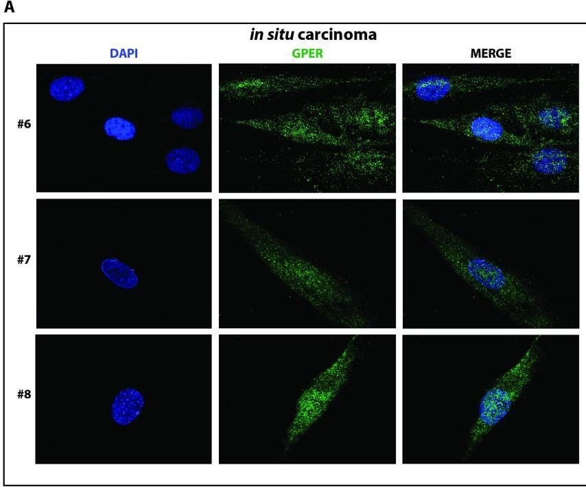 Fig.5.A showing Immunocytochemistry-immunofluorescence from the publication: A genetic polymorphism repurposes the G-protein coupled and membrane-associated estrogen receptor GPER to a transcription factor-like molecule promoting paracrine signaling between stroma and breast carcinoma cells.