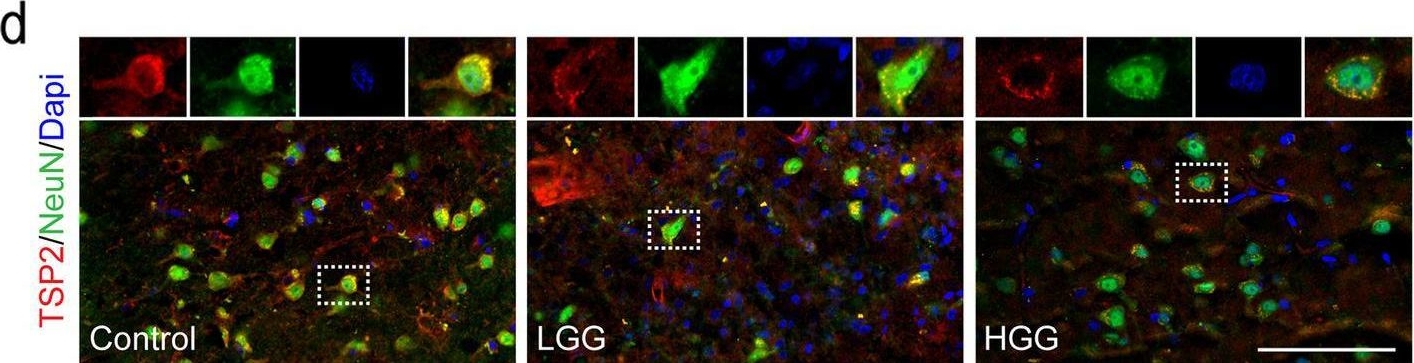 Fig.1.D showing Immunohistochemistry-immunofluorescence from the publication: Thrombospondin-2 promotes the proliferation and migration of glioma cells and contributes to the progression of glioma.