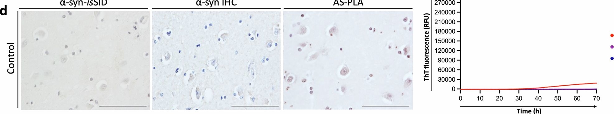 Fig.2.D showing Immunohistochemistry from the publication: Novel in situ seeding immunodetection assay uncovers neuronal-driven alpha-synuclein seeding in Parkinson's disease.
