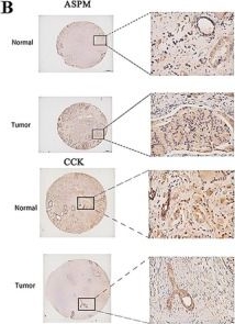 Fig.11.B showing Immunohistochemistry in a Homo sapiens (Human) sample from the publication: An Integrative Methylation-Metabolism Gene Signature Defines Prognosis and Immunosuppressive Microenvironment in Prostate Cancer.