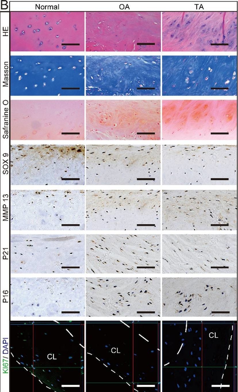 Fig.1.B showing Immunohistochemistry in a Homo sapiens (Human) sample from the publication: Triamcinolone acetonide-loaded nanoparticles encapsulated by CD90+ MCSs-derived microvesicles drive anti-inflammatory properties and promote cartilage regeneration after osteoarthritis.