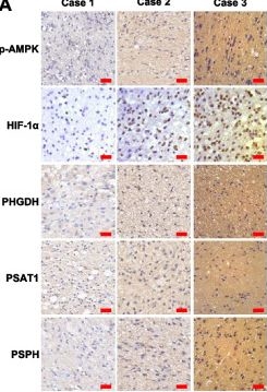 Fig.7.A showing Immunohistochemistry in a Homo sapiens (Human) sample from the publication: AMPK-HIF-1α signaling enhances glucose-derived de novo serine biosynthesis to promote glioblastoma growth.