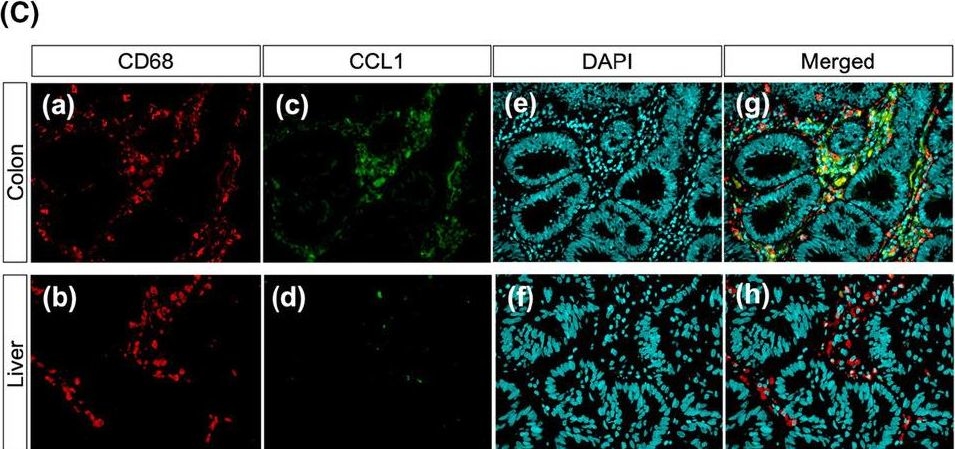 Fig.2.C showing Immunohistochemistry-immunofluorescence in a Homo sapiens (Human) sample from the publication: Reduced chemokine C-C motif ligand 1 expression may negatively regulate colorectal cancer progression at liver metastatic sites.