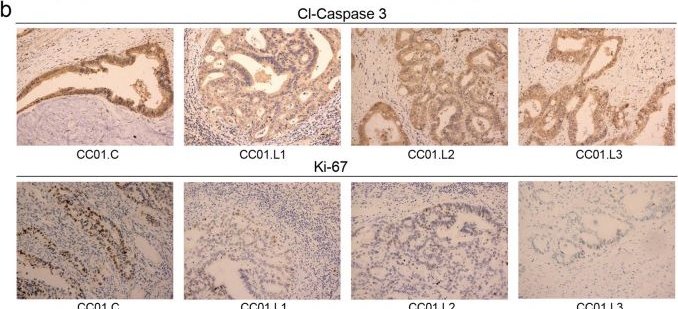 Fig.5.B showing Immunohistochemistry from the publication: The clonal heterogeneity of colon cancer with liver metastases.
