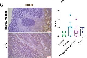 Fig.3.G showing Immunohistochemistry in a Homo sapiens (Human) sample from the publication: Mast cell release of TNF-α indirectly contributes to recalling B cells in the colorectal cancer milieu through the CCL20/CCR6 axis.