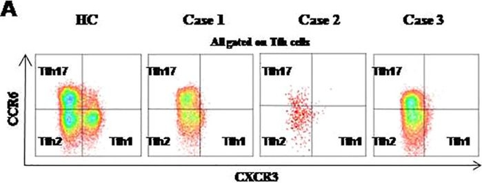 Fig.2.A showing Flow cytometry/Cell sorting in a Homo sapiens (Human) sample from the publication: Significant decreased CXCR3+ phenotype Tfh1 cells in three Good's syndrome patients.