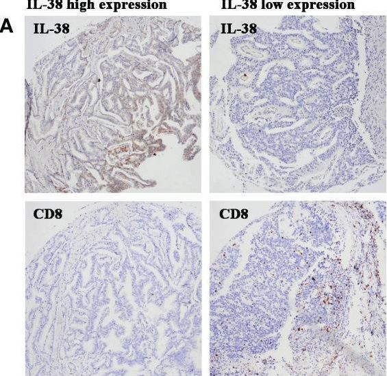 Fig.3.A showing Immunohistochemistry from the publication: IL-38 promotes the development of prostate cancer.