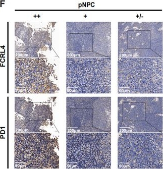 Fig.8.F showing Immunohistochemistry from the publication: CD20+FCRL4+ B Cells Activate CD8+ T Cells via MHC-I Restriction in Nasopharyngeal Carcinoma Anti-Tumor Immunity.