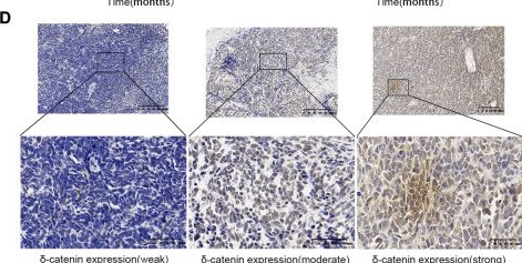 Fig.2.D showing Immunohistochemistry from the publication: Delta-catenin attenuates medulloblastoma cell invasion by targeting EMT pathway.