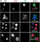 Fig.1.C showing Immunocytochemistry-immunofluorescence from the publication: Circulating tumor cells and clusters as liquid biomarkers for the diagnosis and prognosis of neuroblastoma.