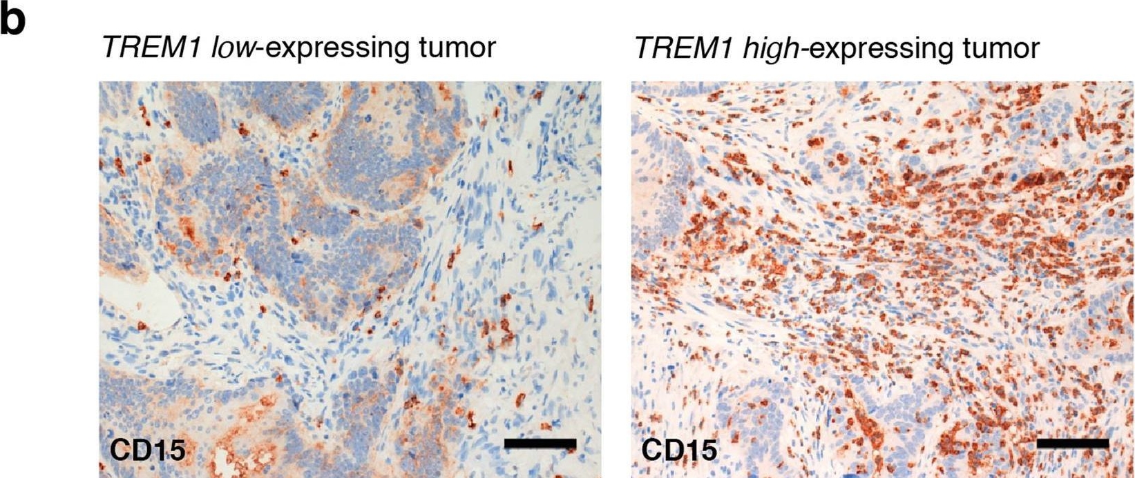 Fig.5.B showing Immunohistochemistry in a Homo sapiens (Human) sample from the publication: TREM-1 promotes intestinal tumorigenesis.