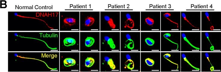 Fig.5.B showing Immunocytochemistry-immunofluorescence in a Homo sapiens (Human) sample from the publication: DNAH3 deficiency causes flagellar inner dynein arm loss and male infertility in humans and mice.