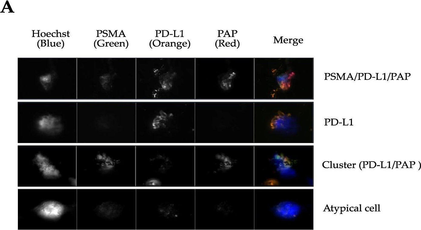 Fig.4.A showing Immunocytochemistry-immunofluorescence in a Homo sapiens (Human) sample from the publication: Circulating Tumor Cell Persistence Associates with Long-Term Clinical Outcome to a Therapeutic Cancer Vaccine in Prostate Cancer.