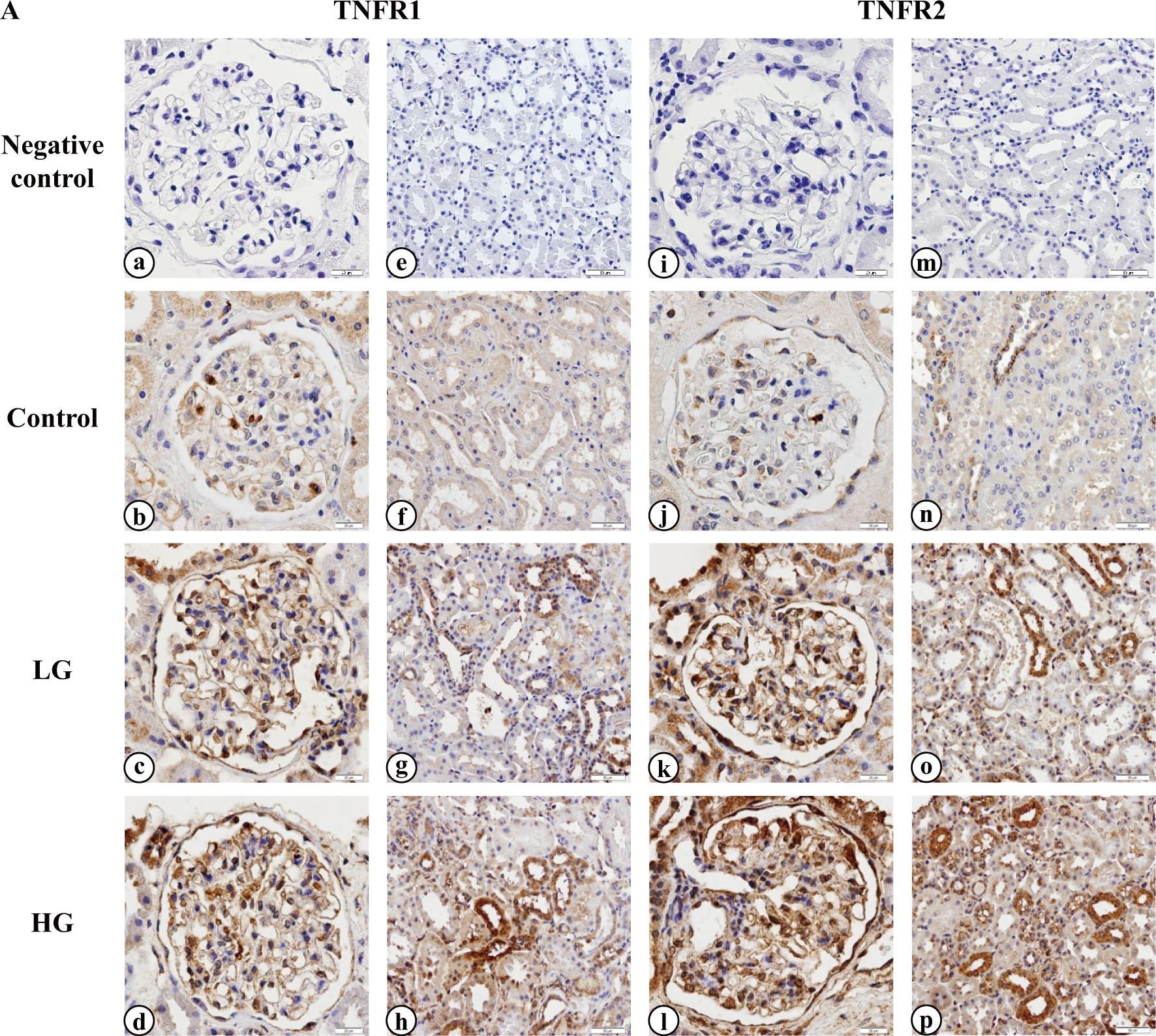 Fig.2.A showing Immunohistochemistry in a Homo sapiens (Human) sample from the publication: Circulating TNF receptors 1 and 2 are associated with the severity of renal interstitial fibrosis in IgA nephropathy.