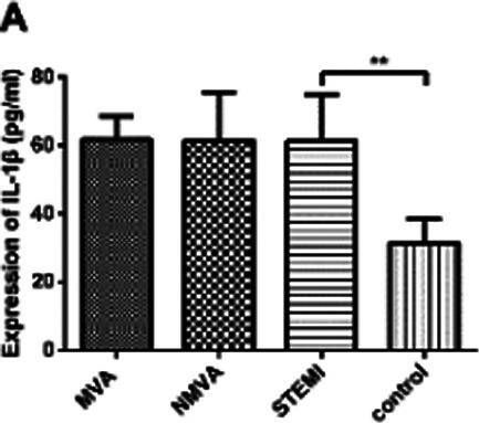 Fig.2.A showing Enzyme-linked immunosorbent assay from the publication: Expression and clinical significance of NRLP1 in patients with ST-segment elevation myocardial infarction combined with malignant ventricular arrhythmia.
