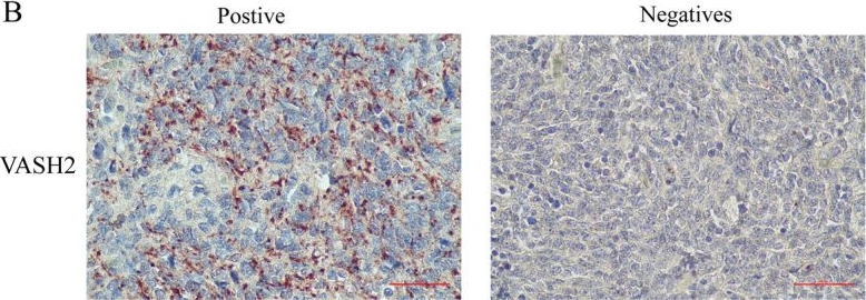 Fig.1.B showing Immunohistochemistry in a Homo sapiens (Human) sample from the publication: A preliminary study on the mechanism of VASH2 in childhood medulloblastoma.