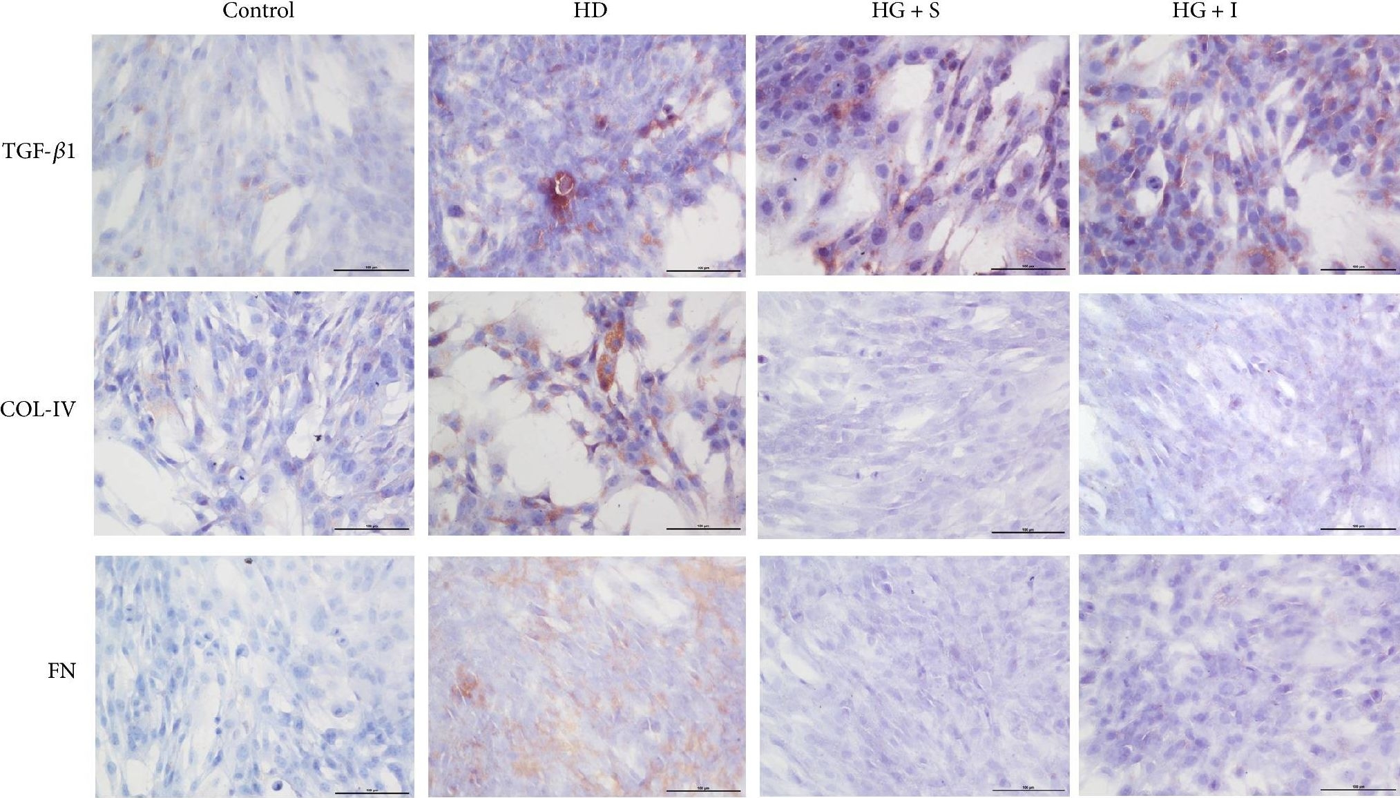 Fig.6.A showing Immunohistochemistry in a Rattus norvegicus (Rat) sample from the publication: Renoprotective Effect of the Shen-Yan-Fang-Shuai Formula by Inhibiting TNF-α/NF-κB Signaling Pathway in Diabetic Rats.
