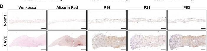 Fig.1.D showing Immunohistochemistry in a Homo sapiens (Human) sample from the publication: Morusin Alleviates Aortic Valve Calcification by Inhibiting Valve Interstitial Cell Senescence Through Ccnd1/Trim25/Nrf2 Axis.