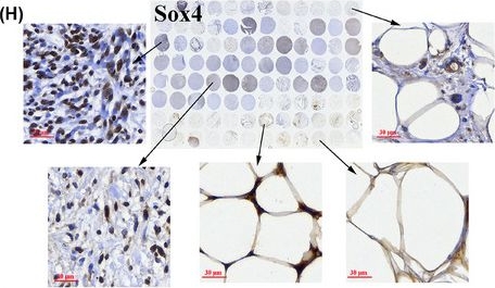 Fig.4.H showing Immunohistochemistry in a Homo sapiens (Human) sample from the publication: Oncogenic driver and therapeutic target: Prolactin signalling axis in retroperitoneal sarcoma.
