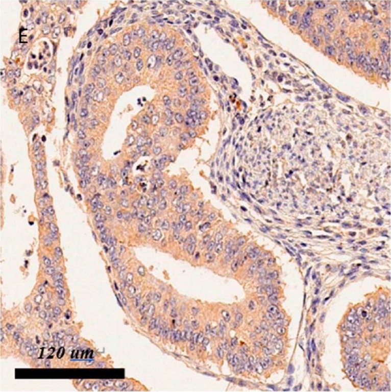 Fig.1.E showing Immunohistochemistry in a Homo sapiens (Human) sample from the publication: Expression of the Hippo Pathway Core Components in Endometrial Cancer and Its Association with Clinicopathologic Features.