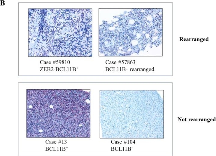 Fig.3.B showing Immunohistochemistry in a Homo sapiens (Human) sample from the publication: Novel and Rare Fusion Transcripts Involving Transcription Factors and Tumor Suppressor Genes in Acute Myeloid Leukemia.