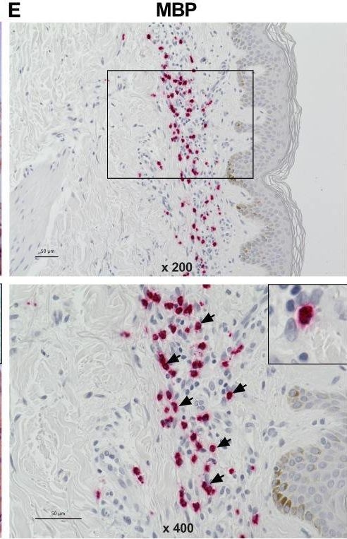 Fig.1.E showing Immunohistochemistry in a Homo sapiens (Human) sample from the publication: The Number of MRGPRX2-Expressing Cells Is Increased in Skin Lesions of Patients With Indolent Systemic Mastocytosis, But Is Not Linked to Symptom Severity.