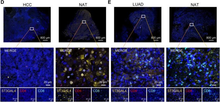 Fig.8.D showing Immunohistochemistry-immunofluorescence from the publication: Systematic Pan-Cancer Characterization of ST3GAL4 Reveals Its Prognostic and Immunologic Associations.
