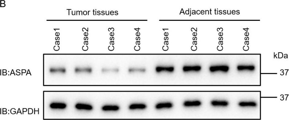 Fig.1.B showing Western Blotting in a Homo sapiens (Human) sample from the publication: Aspartoacylase promotes the process of tumour development and is associated with immune infiltrates in gastric cancer.