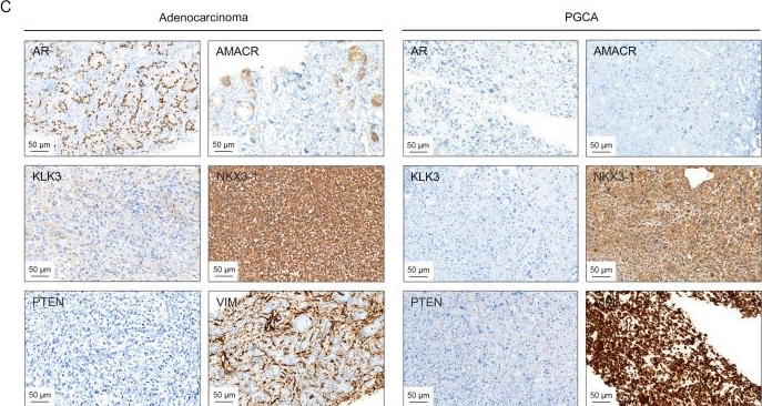 Fig.1.C showing Immunohistochemistry in a Homo sapiens (Human) sample from the publication: Clonal divergence and genomic meltdown in prostatic pleomorphic giant cell adenocarcinoma.