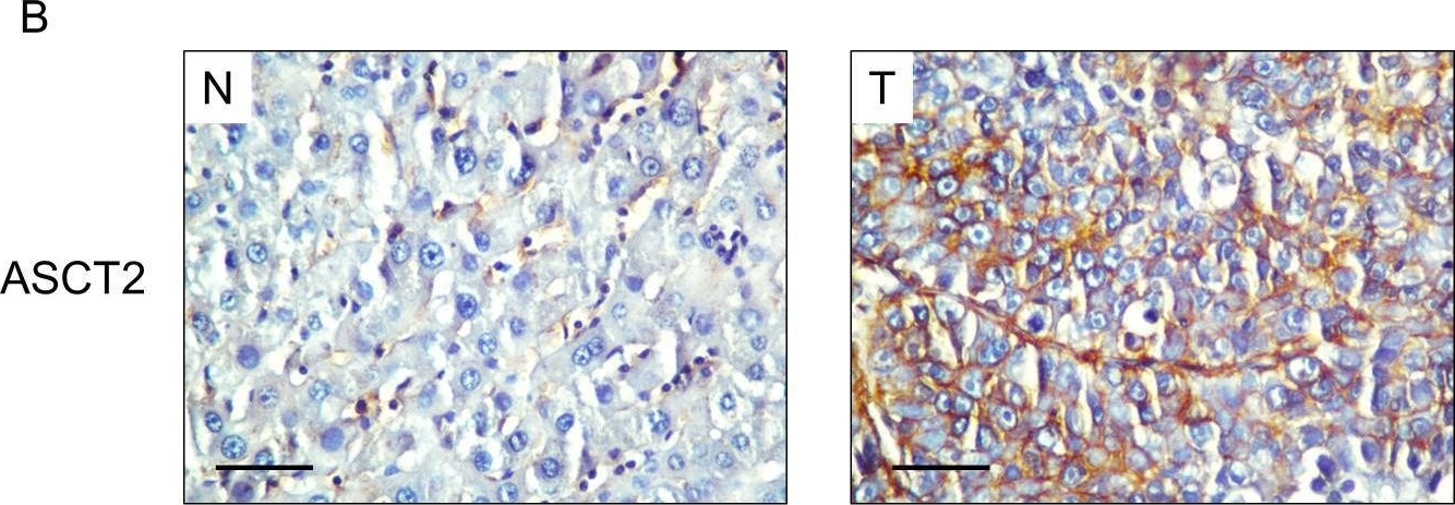 Fig.1.B showing Immunohistochemistry from the publication: GLUT1 and ASCT2 as Predictors for Prognosis of Hepatocellular Carcinoma.